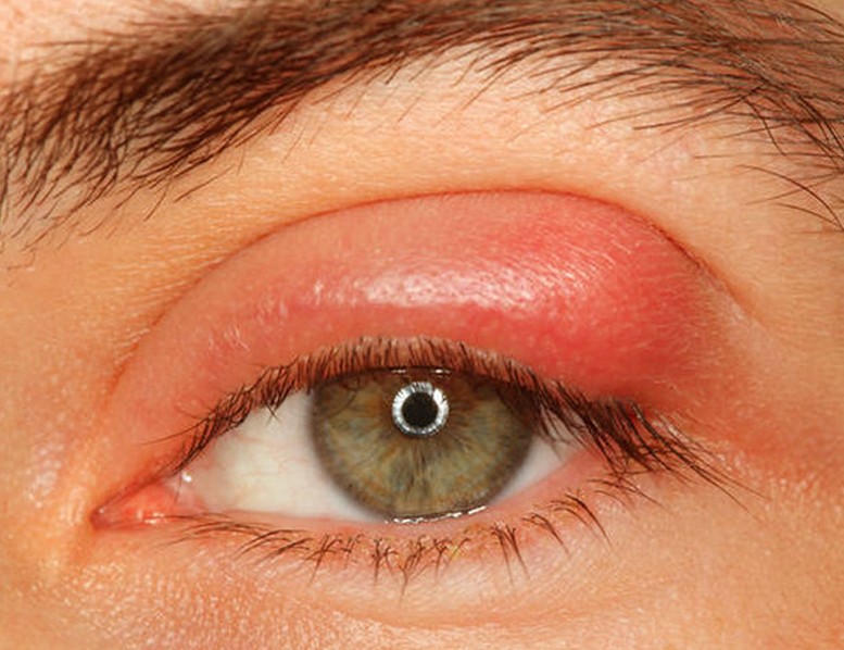بیماریپینگوکولا چشمی