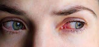 بیماری قرنیه ی چشمی زونا